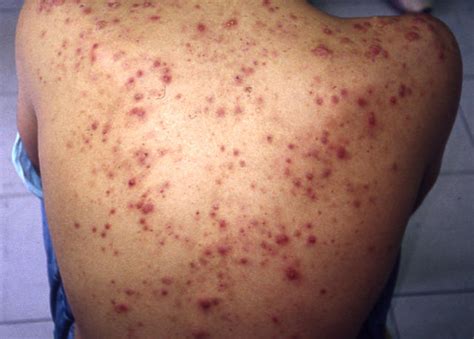 Diseases Of The Sebaceous Glands Acne Inflammatory Picture