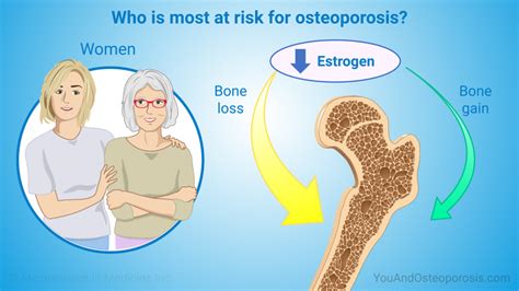Slide Show Understanding Bone Health And Osteoporosis