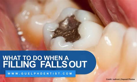 What To Do When A Filling Falls Out Guelph Dentist