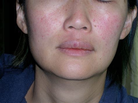 A Journey Into Obliterating Rosacea May 2010