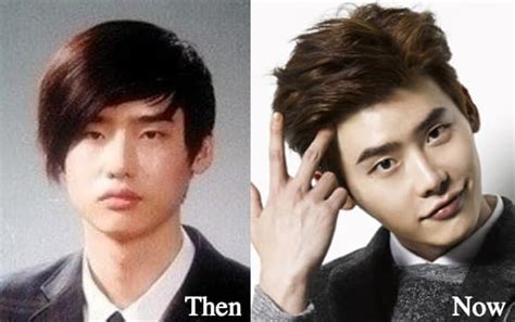 Lee Jong Suk Plastic Surgery Before And After