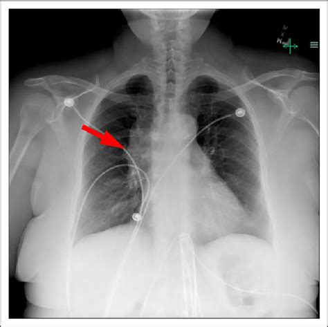 Chest Radiography Shows An Enlarged Mediastinal Shadow On The Right