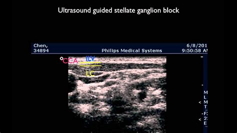 Ultrasound Guided Stellate Ganglion Block Youtube