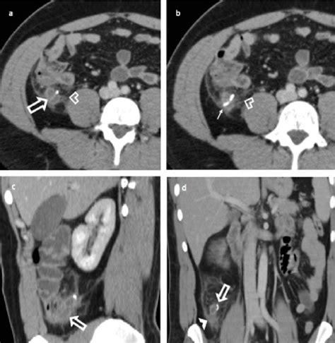 Axial Contrast Enhanced Ct Scan Series Of Abdomen A B Show Enlarged