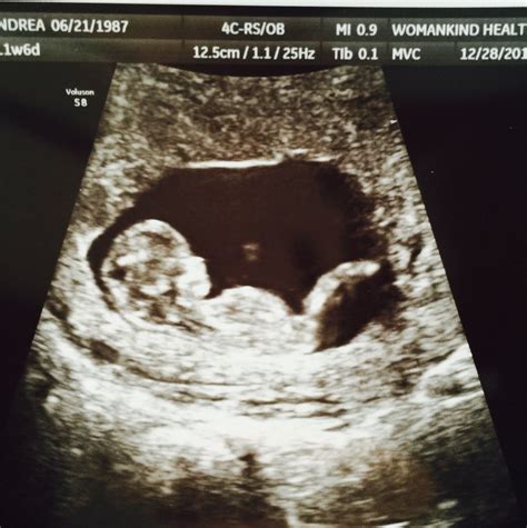Ultrasound At 11 Weeks Pregnant Images And Photos Finder