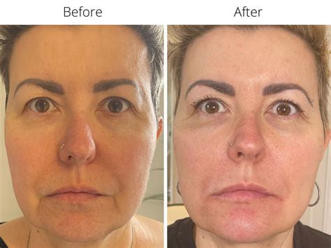 Marionette Lines Treatments With Dermal Fillers Or Botox Melior Clinics