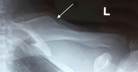 Clavicle Malunion In A 29 Year Old