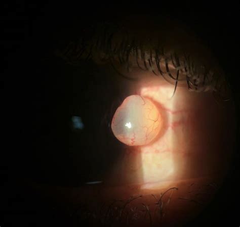 Conjunctival Inclusion Cyst Eyewiki
