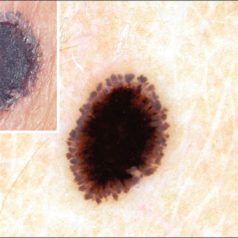 Clinical Characteristics Of 83 Cases Of Spitz Nevus By Provisional