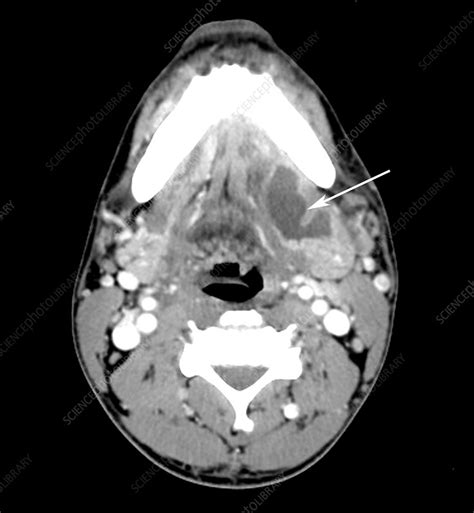 Submandibular Gland Abscess Ct Scan Stock Image C0270923