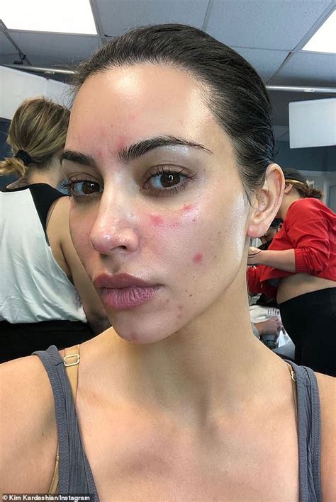 Kim Kardashian Shares Brutally Honest Account Of Living With Psoriasis Daily Mail Online