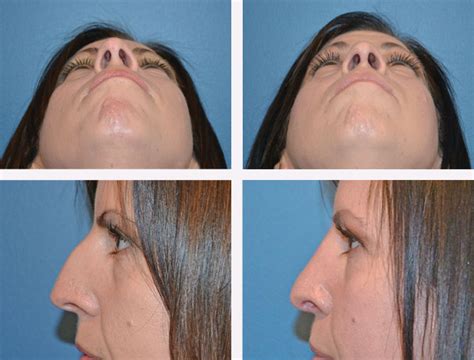 I want to get a nose job done to fix the appearance of my nose and also some breathing problems. Rhinoplasty (nose job) Nose Surgery | Dr. Johnson ...
