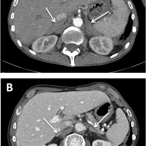 A Post Contrast Adrenal Ct Scan Showing Bilateral Homogeneous Masses