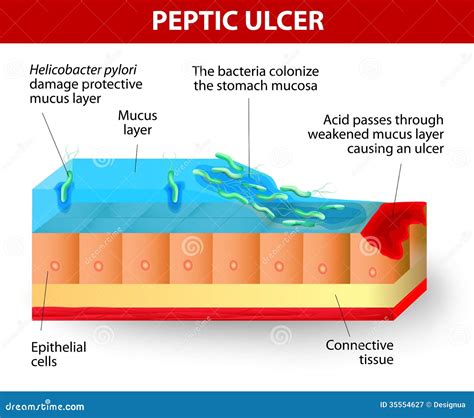 Helicobacter Pylori And Ulcers Disease Coloso