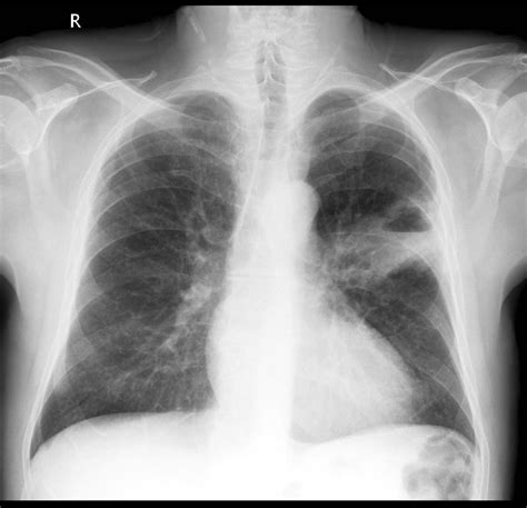 Lung Mass X Ray Wikidoc