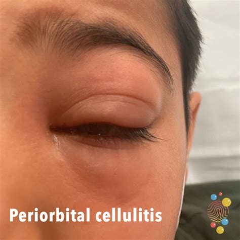 Eye Orbital Cellulitis