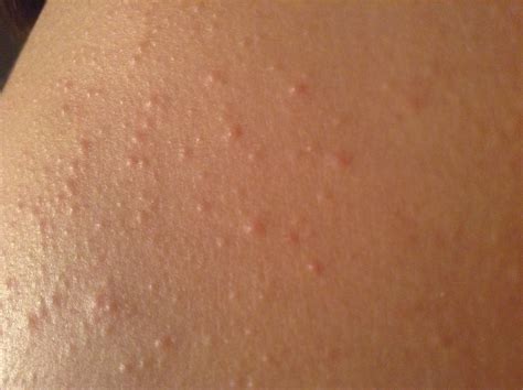 The cause could be as minor as dry skin or as serious as kidney disease from diabetes. White Bumps On Back Of Arms | Dorothee Padraig South West ...