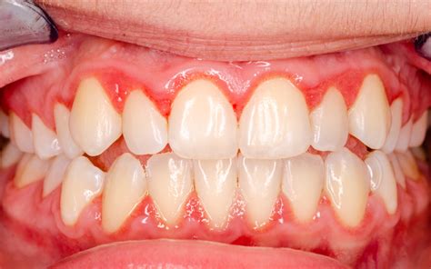 Be Aware Of Gum Disease Leo A Tokarczyk Dds Pc