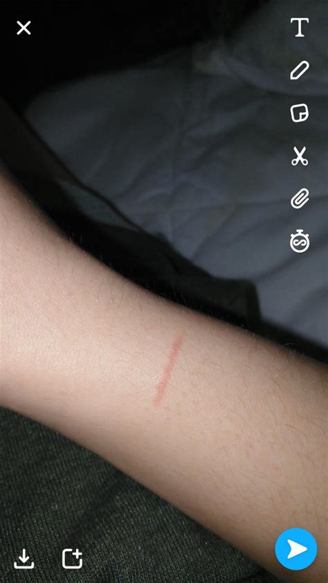 What Is This Red Line On My Arm Girlsaskguys