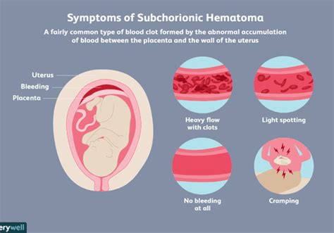 Subchorionisches Hämatom Und Schwangerschaftsrisiken Medde