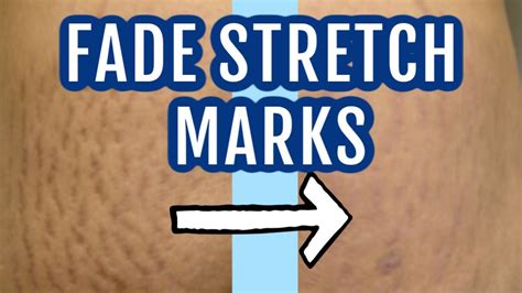 7 Ways To Fade Stretch Marks Dr Dray Youtube