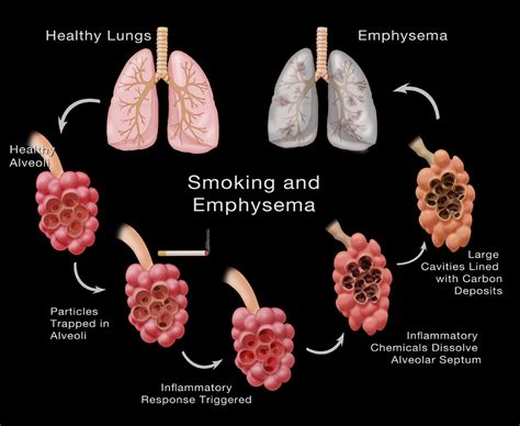 Pneumonia is a lung infection that leads to breathing difficulties and fluid in the lungs. Oxygen As a Medical Drug - PRETEND Magazine