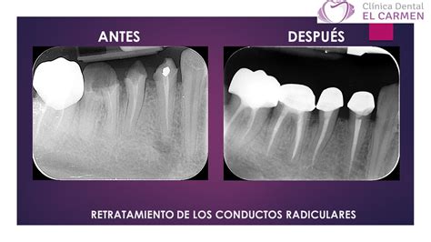 Clínica Dental El Carmen Retratamiento De Los Conductos Radiculares