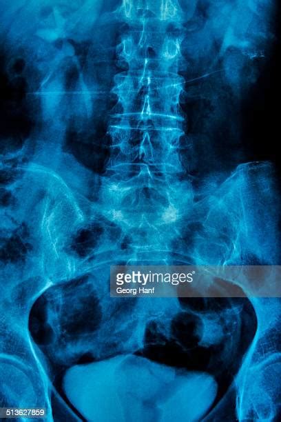 Pelvic Xray Photos And Premium High Res Pictures Getty Images