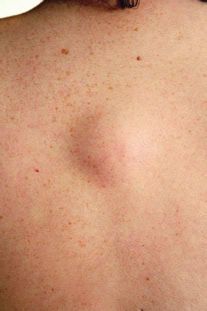 Treatment For Lipomas Cysts And Moles In Nj Short Hills Dermatology