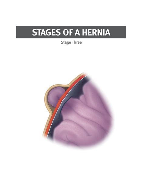 Creativejake Weien Stages Of A Hernia Illustrations