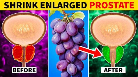 10 Foods That Will Shrink Your Enlarged Prostate Youtube