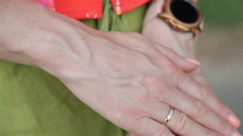 Bulging Veins On Women`s Arms Stock Photo Image Of Care Arthritis