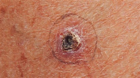 You might be a candidate for genetic testing to see whether. What Is Basal Cell Carcinoma Skin Cancer? | Everyday Health