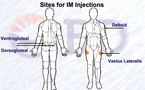 Sites For Intramuscular Im Injection Nursing Schools In Texas Nursing