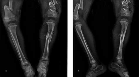 Typically in elderly, osteoporotic patients. Right Femoral Shaft Fractures (OTA Classification 32-A3 ...