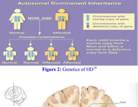 Pdf Huntingtons Disease From Molecular Pathogenesis To Clinical