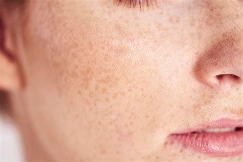 Skincare Advice For People With Freckles The Healthy