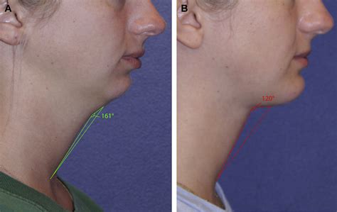 Understanding Deep Neck Anatomy And Its Clinical Relevance Clinics In
