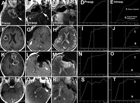 Using Intraoperative Dynamic Contrast Enhanced T1 Weighted Mri To