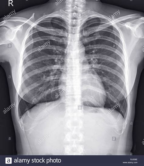 Heart Normal Heart Size On Chest X Ray