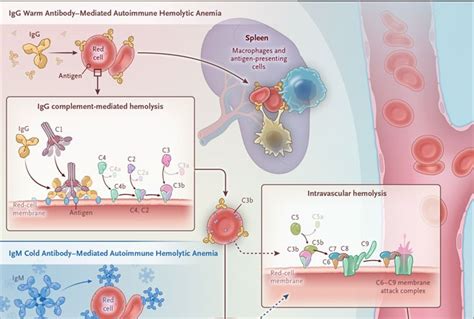Autoimmune Hemolytic Anemias Nejm Resident 360