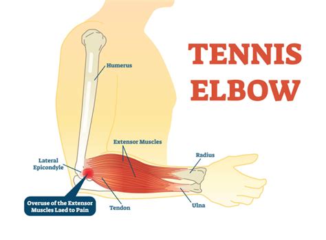 What Is Tennis Elbow And What Can I Do About It Ask The Team At
