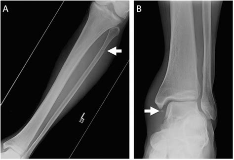 Splint For Distal Fibula Fracture