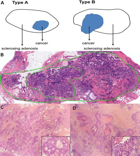 Breast Carcinoma In Sclerosing Adenosis A Clinicopathological And