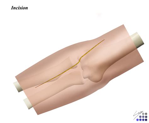 Elbow Anterolateral Approach Approaches Orthobullets