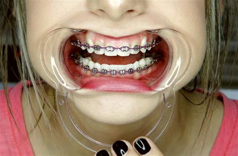 Braces Girlswithbraces Metalbraces Elastics Powerchain Dental My Xxx