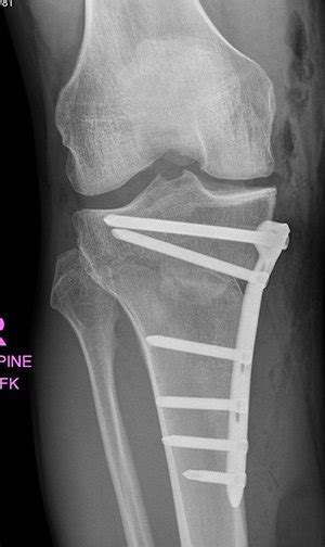 Knee Osteotomy Sydney Knee Specialists