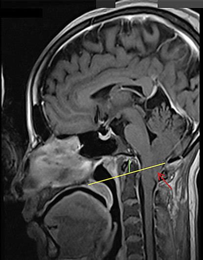 Mri Of Brain Report Peg Like Cerebellar Tonsillar Herniation 2 Cm