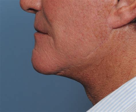 Plastic Surgery Case Study Scar Outcome From A Direct Jawline