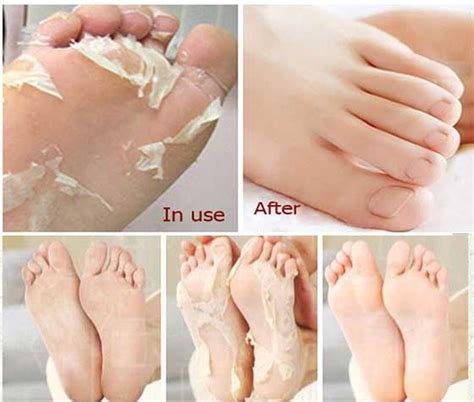 Get Smooth Baby Soft Skin On Your Feet No Dry Skin Or Cracks Anymore
